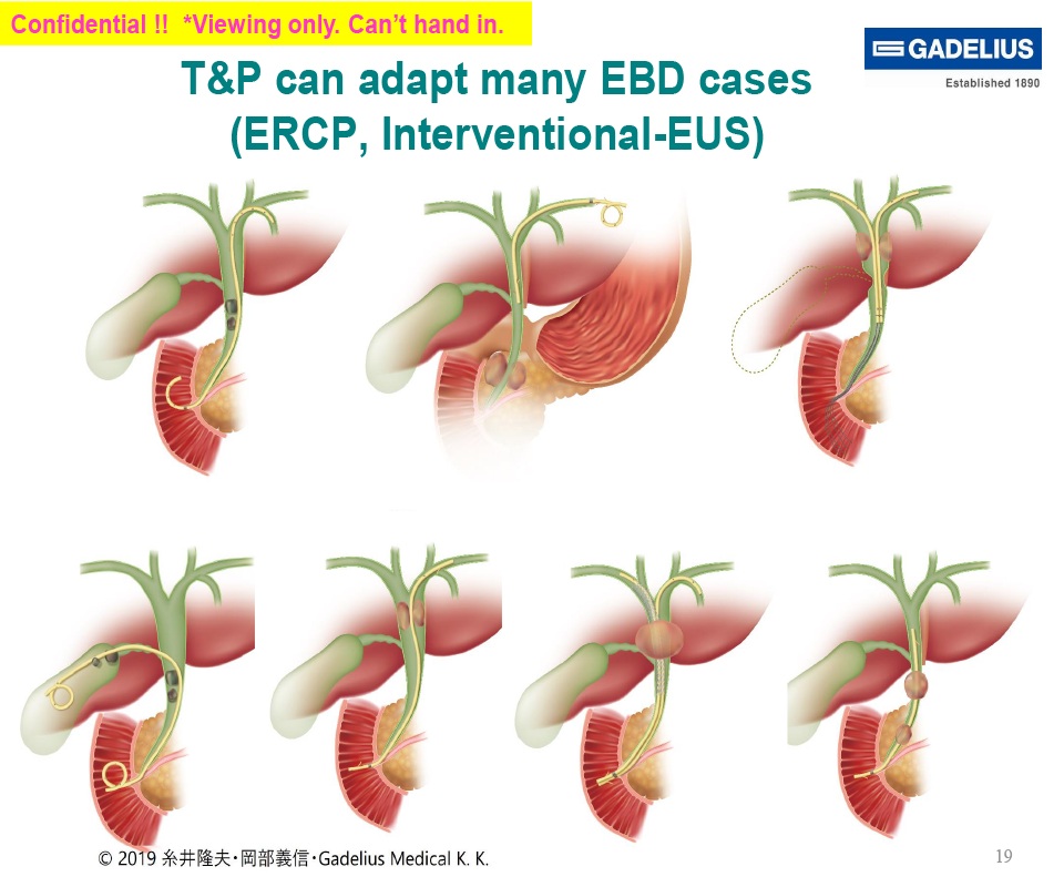 ERCP, Interventional