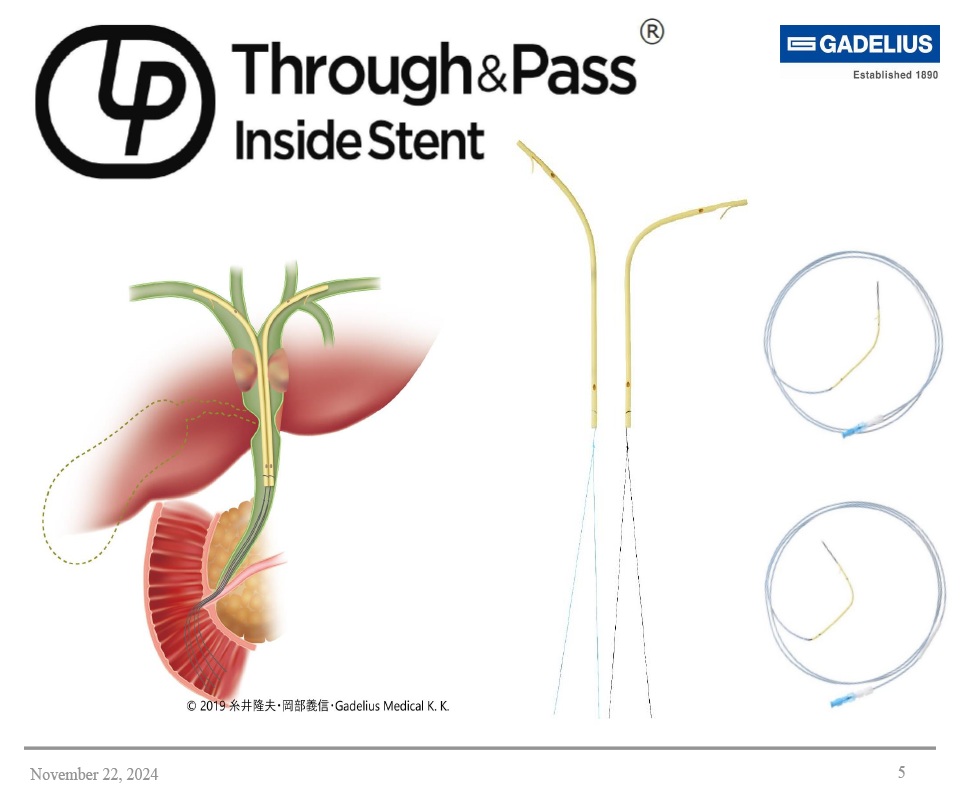 Inside Stent