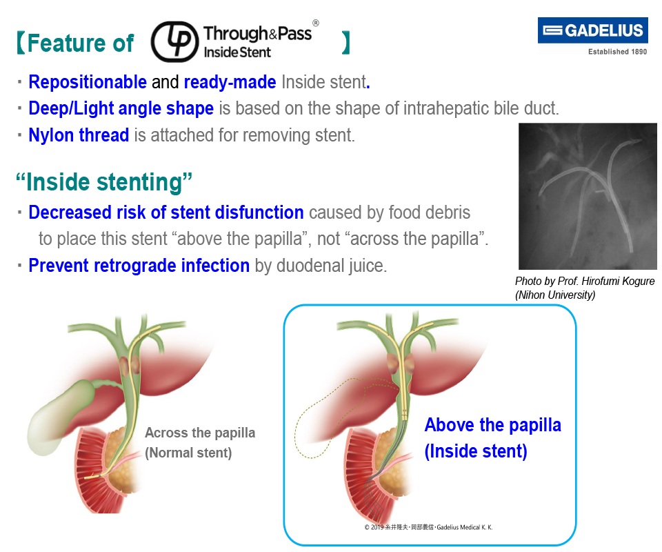 Inside Stenting
